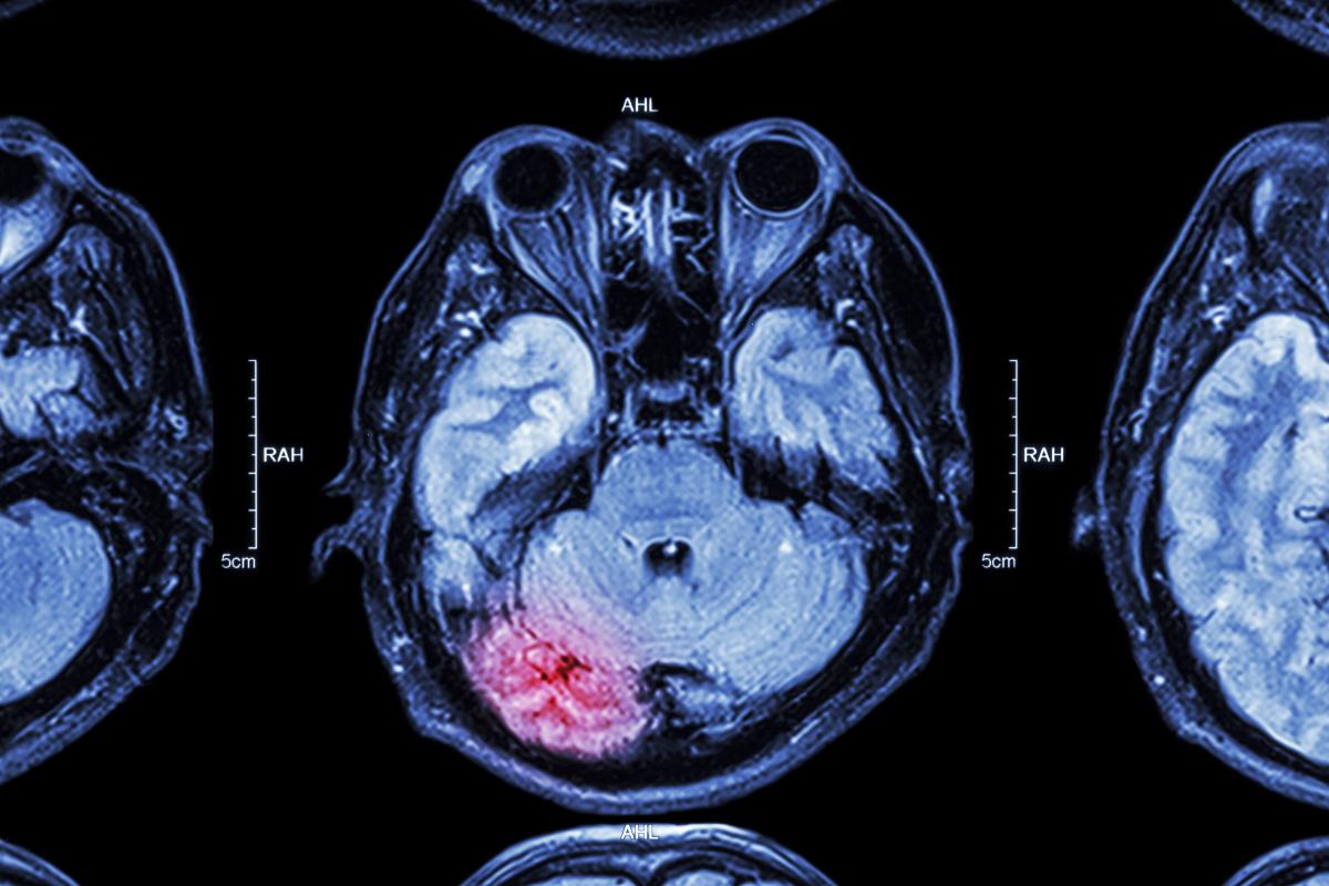 Brain scans in chemo thearpy